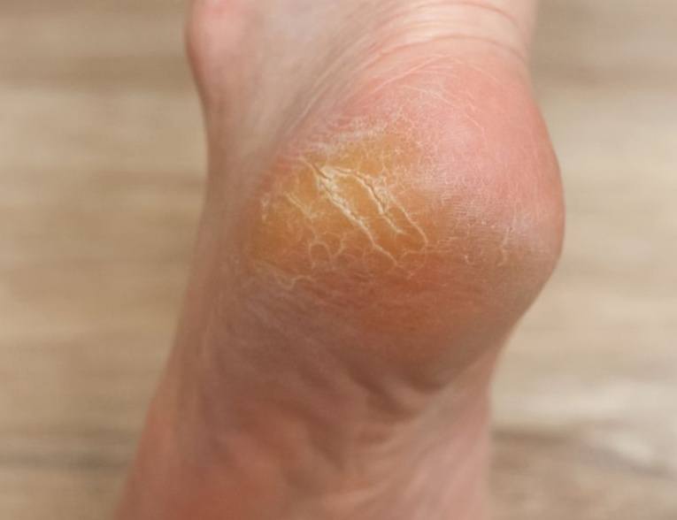 Foot Corn Removal Gel