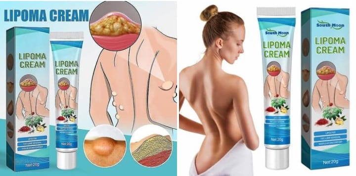Lipoma Removal Cream