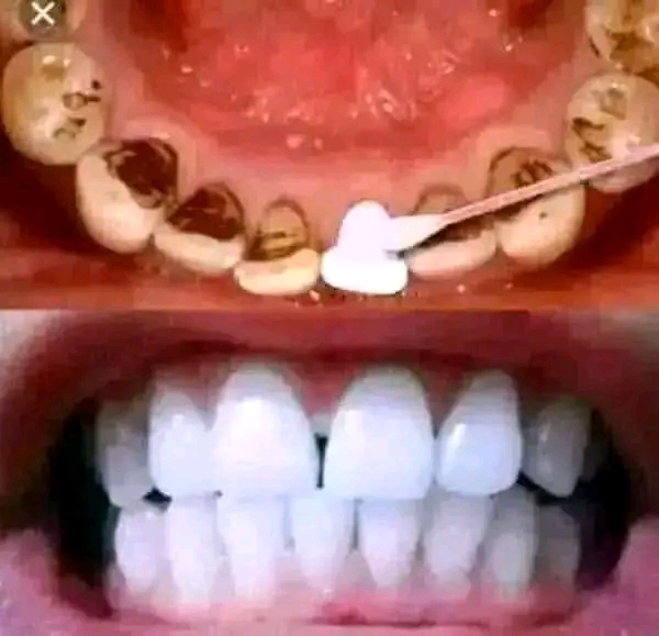 LANBENA Teeth Whitening Mousse